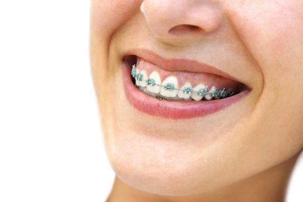 Common questions about braces | Iowa Park Dental